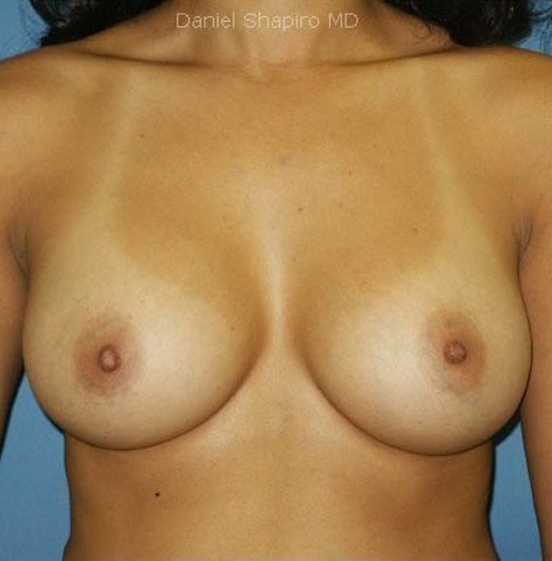 Breast Augmentation Before & After Gallery - Patient 18242007 - Image 2