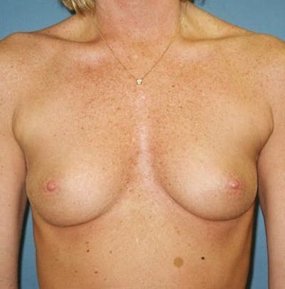 Breast Augmentation Before & After Gallery - Patient 18242009 - Image 1