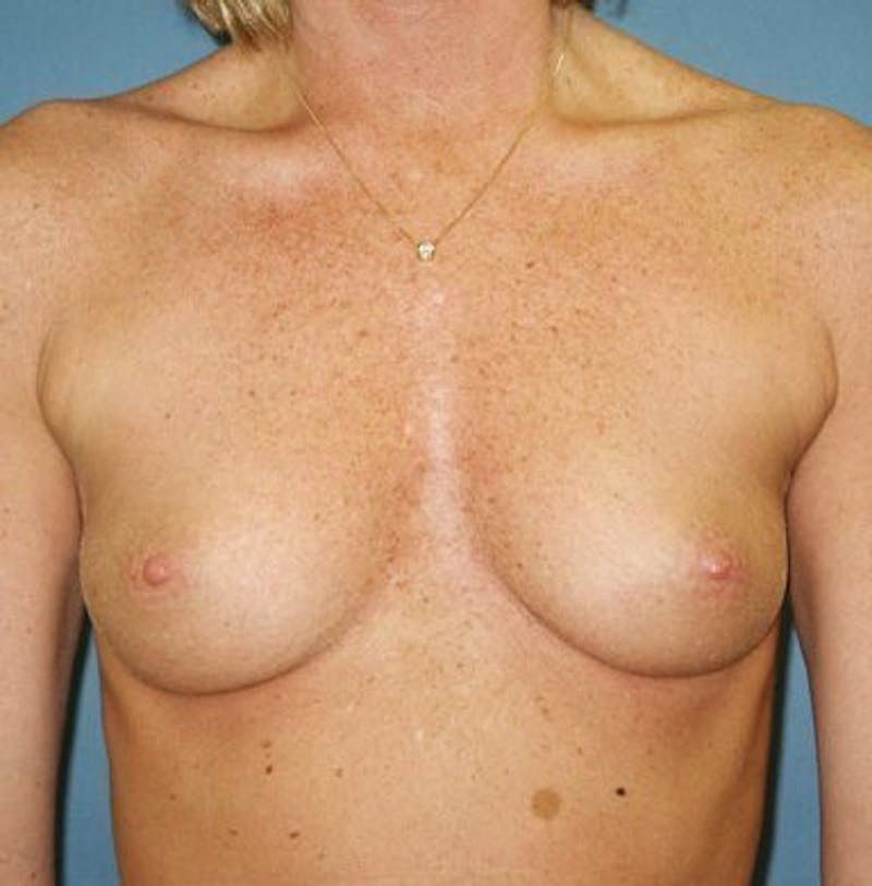 Breast Augmentation Before & After Gallery - Patient 18242009 - Image 1