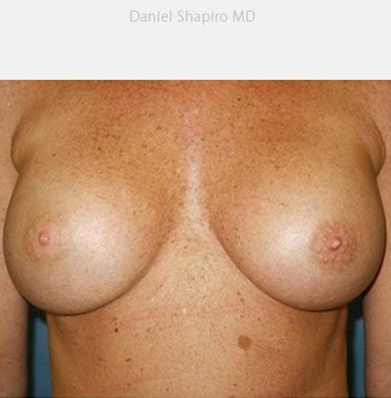 Breast Augmentation Before & After Gallery - Patient 18242009 - Image 2