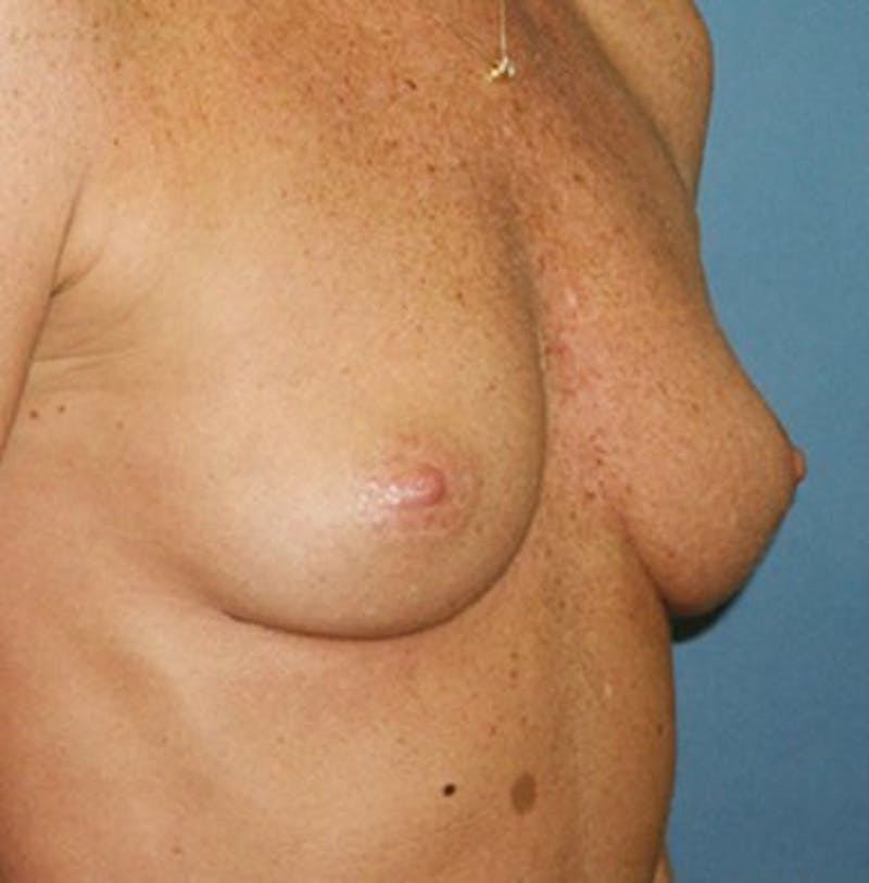 Breast Augmentation Before & After Gallery - Patient 18242009 - Image 3