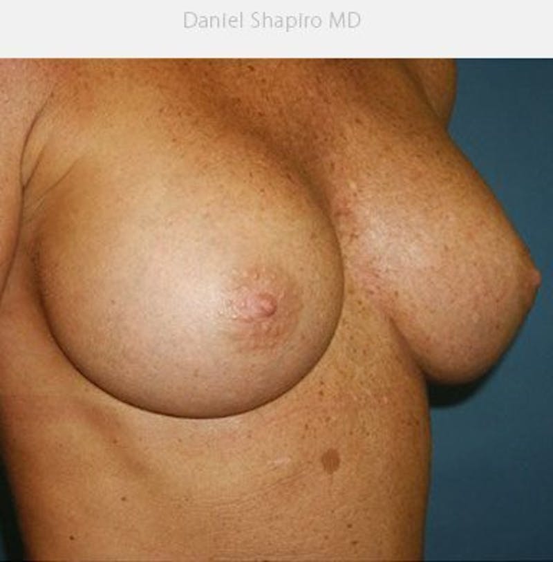 Breast Augmentation Before & After Gallery - Patient 18242009 - Image 4