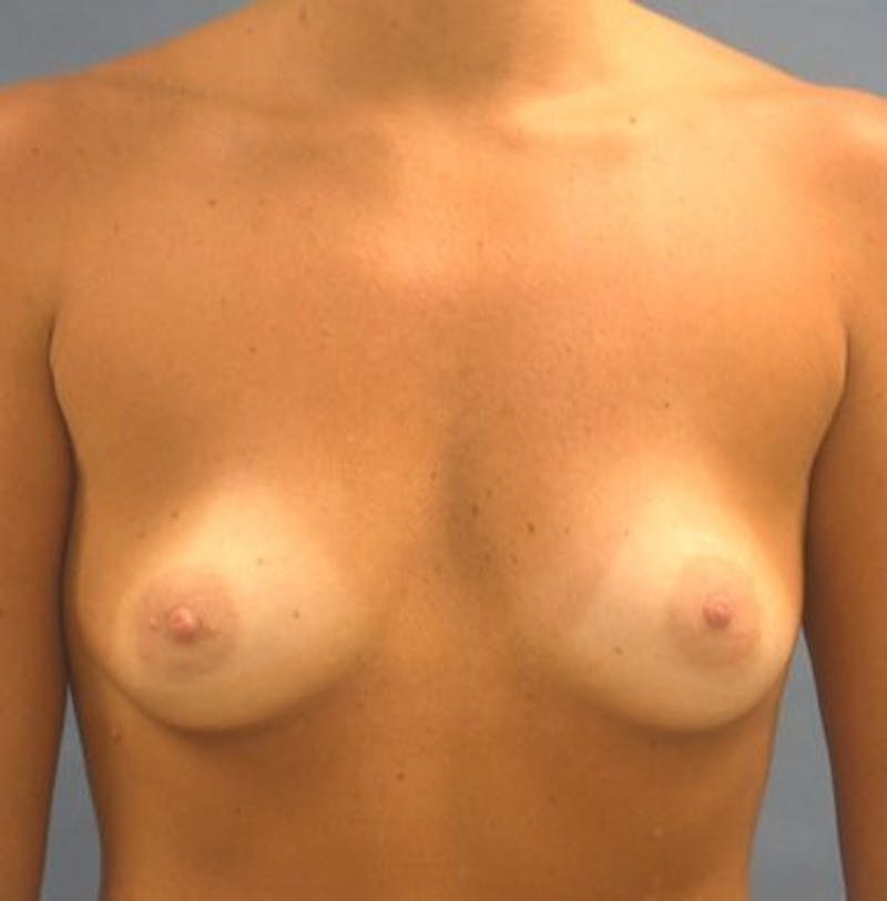 Breast Augmentation Before & After Gallery - Patient 18242012 - Image 1