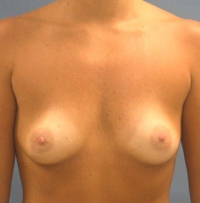 Breast Augmentation Before & After Gallery - Patient 18242012 - Image 1