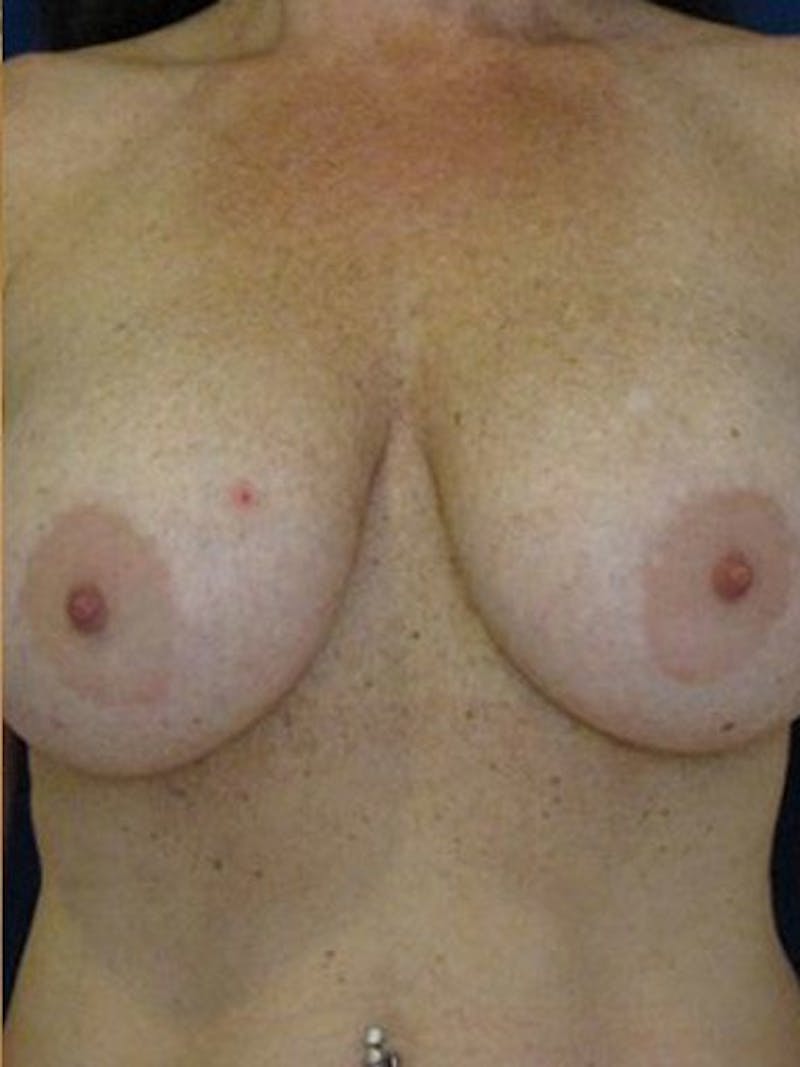 Breast Surgery Revision Before & After Gallery - Patient 18242013 - Image 1