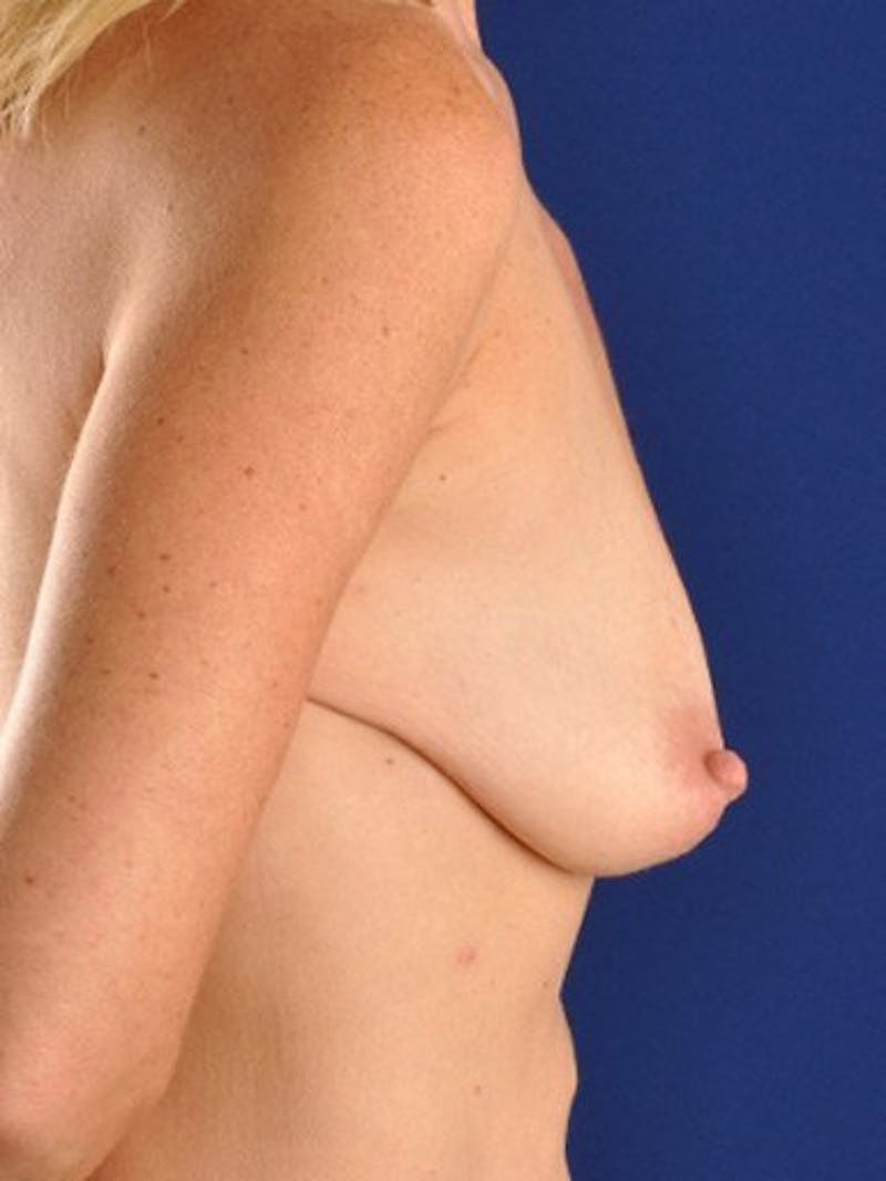 Breast Lift With Augmentation Before & After Gallery - Patient 18242011 - Image 3