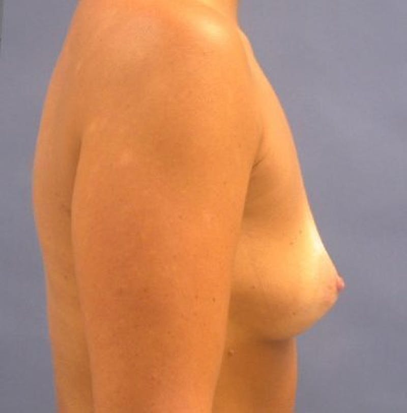 Breast Augmentation Before & After Gallery - Patient 18242012 - Image 3
