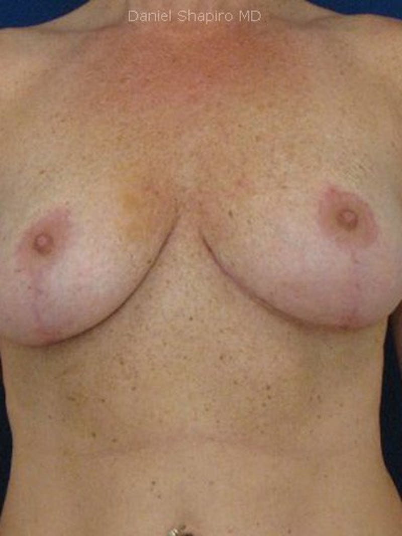 Breast Surgery Revision Before & After Gallery - Patient 18242013 - Image 2