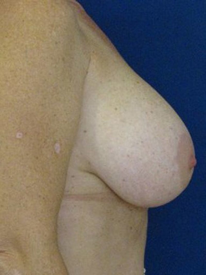 Breast Surgery Revision Before & After Gallery - Patient 18242013 - Image 3