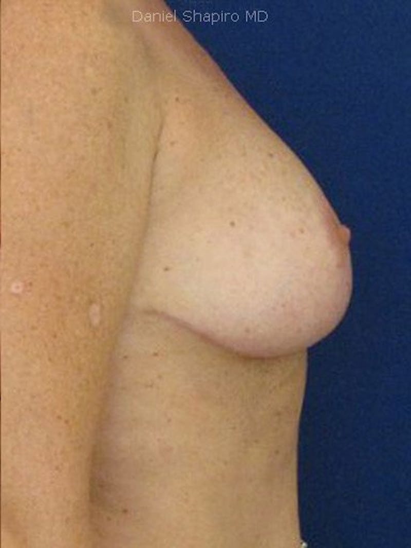 Breast Surgery Revision Before & After Gallery - Patient 18242013 - Image 4