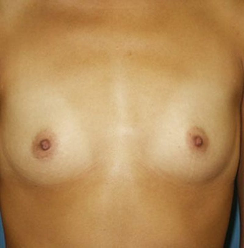 Breast Augmentation Before & After Gallery - Patient 18242023 - Image 1