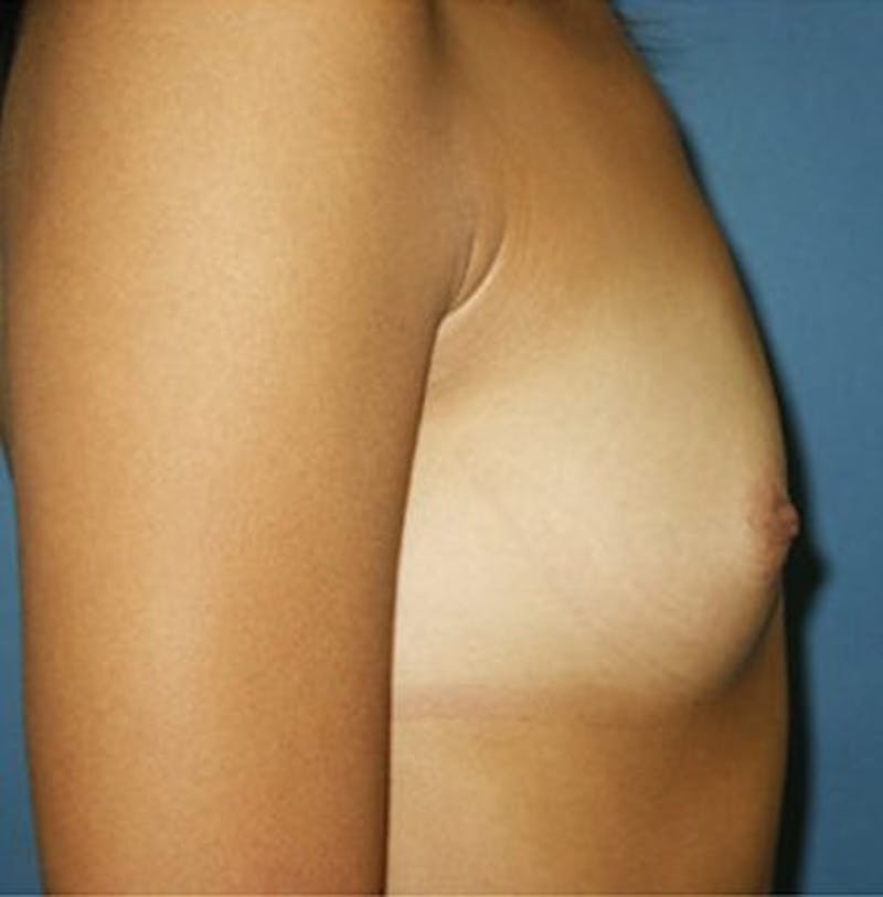 Breast Augmentation Before & After Gallery - Patient 18242023 - Image 3