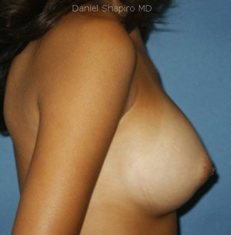 Breast Augmentation Before & After Gallery - Patient 18242023 - Image 4