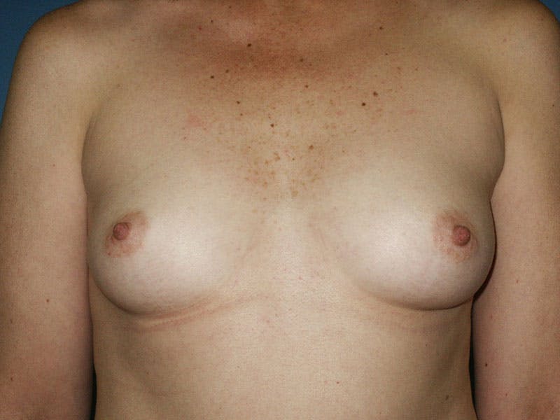 Breast Augmentation Before & After Gallery - Patient 18242036 - Image 1