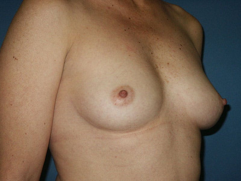 Breast Augmentation Before & After Gallery - Patient 18242036 - Image 3