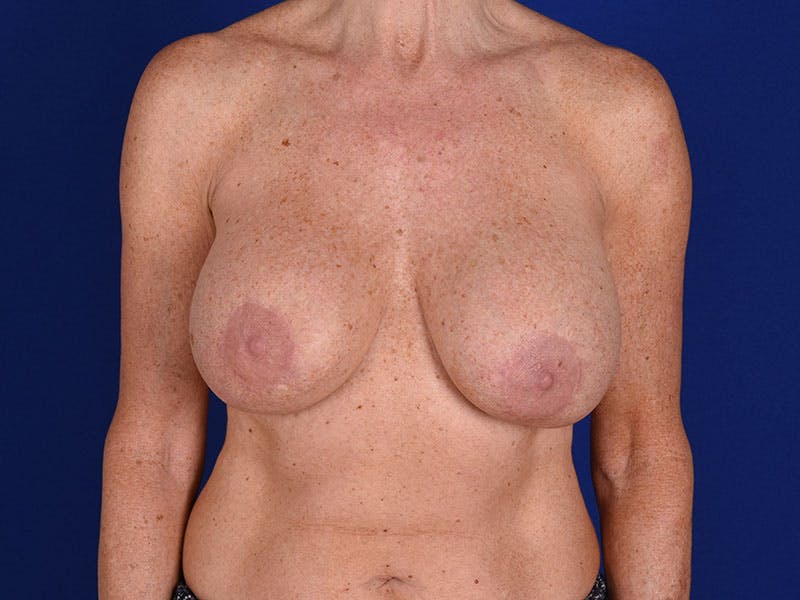 Breast Surgery Revision Before & After Gallery - Patient 18242301 - Image 1