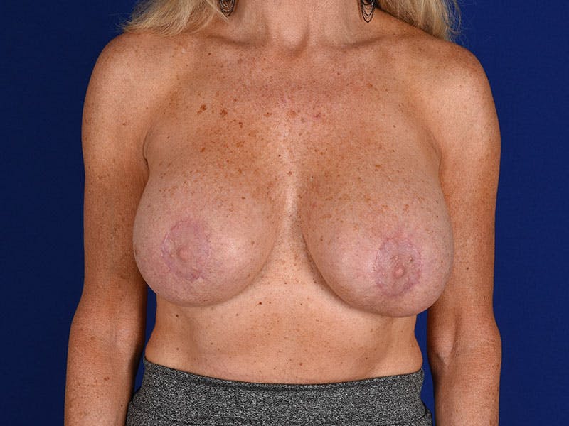 Breast Surgery Revision Before & After Gallery - Patient 18242301 - Image 2