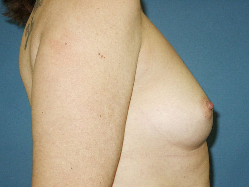 Breast Augmentation Before & After Gallery - Patient 18242036 - Image 5
