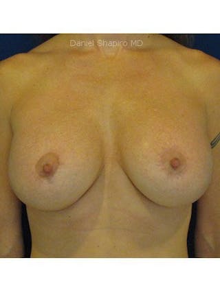 Breast Lift With Augmentation Before & After Gallery - Patient 18242302 - Image 2