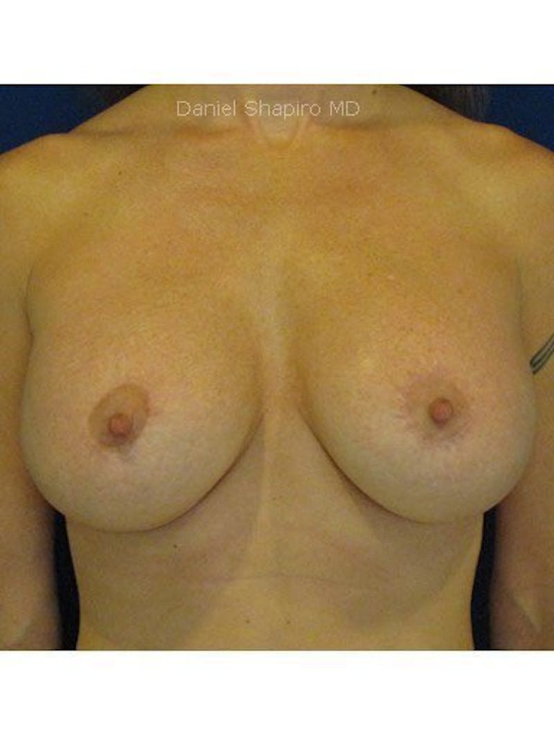 Breast Lift With Augmentation Before & After Gallery - Patient 18242302 - Image 2