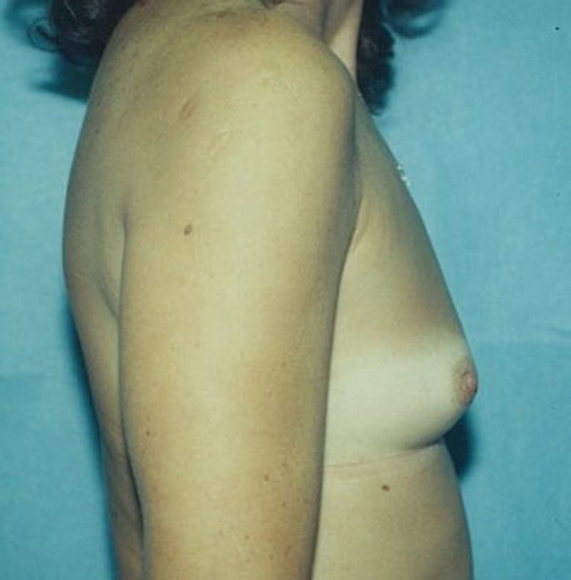 Breast Augmentation Before & After Gallery - Patient 18242304 - Image 3