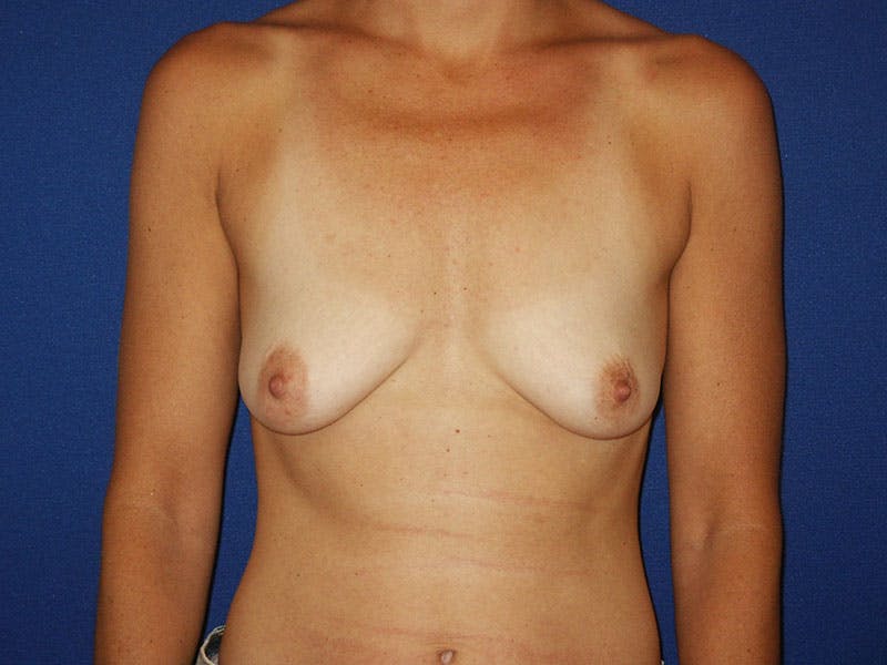 Breast Lift With Augmentation Before & After Gallery - Patient 18242307 - Image 1