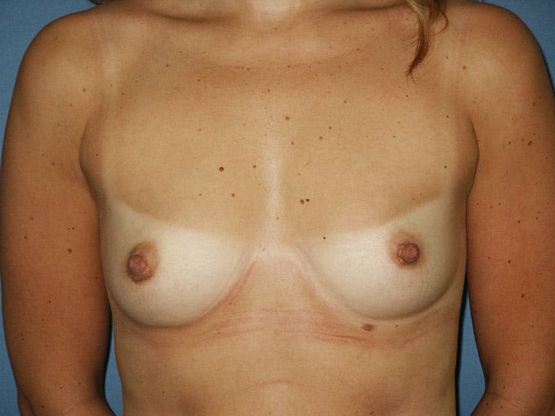Breast Augmentation Before & After Gallery - Patient 18242308 - Image 1