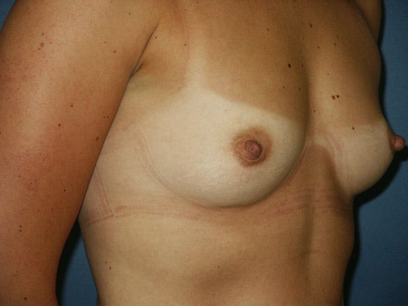 Breast Augmentation Before & After Gallery - Patient 18242308 - Image 3