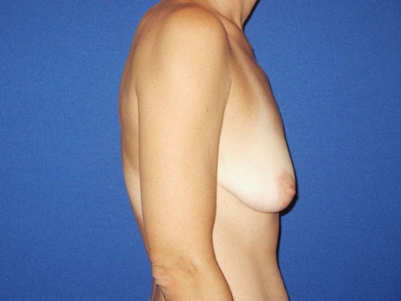 Breast Lift With Augmentation Before & After Gallery - Patient 18242307 - Image 5
