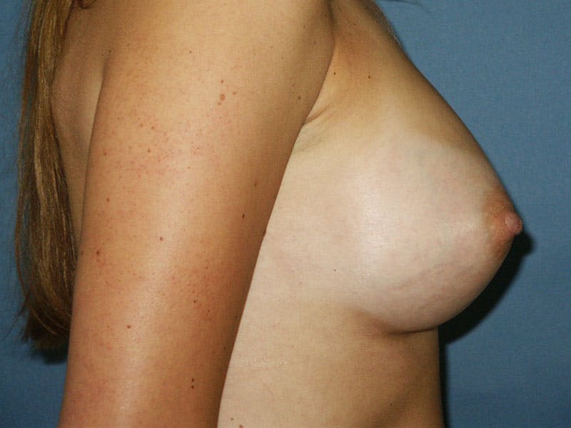 Breast Augmentation Before & After Gallery - Patient 18242308 - Image 6
