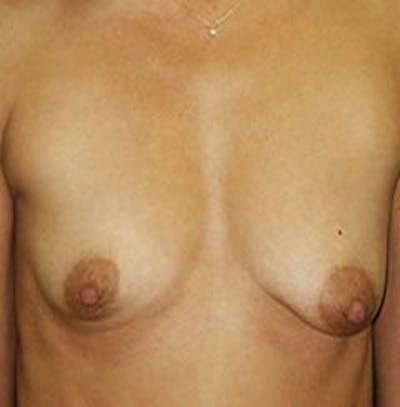 Breast Augmentation Before & After Gallery - Patient 18242312 - Image 1