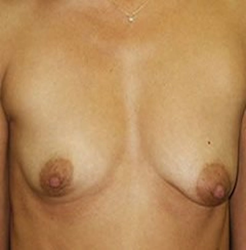 Breast Augmentation Before & After Gallery - Patient 18242312 - Image 1