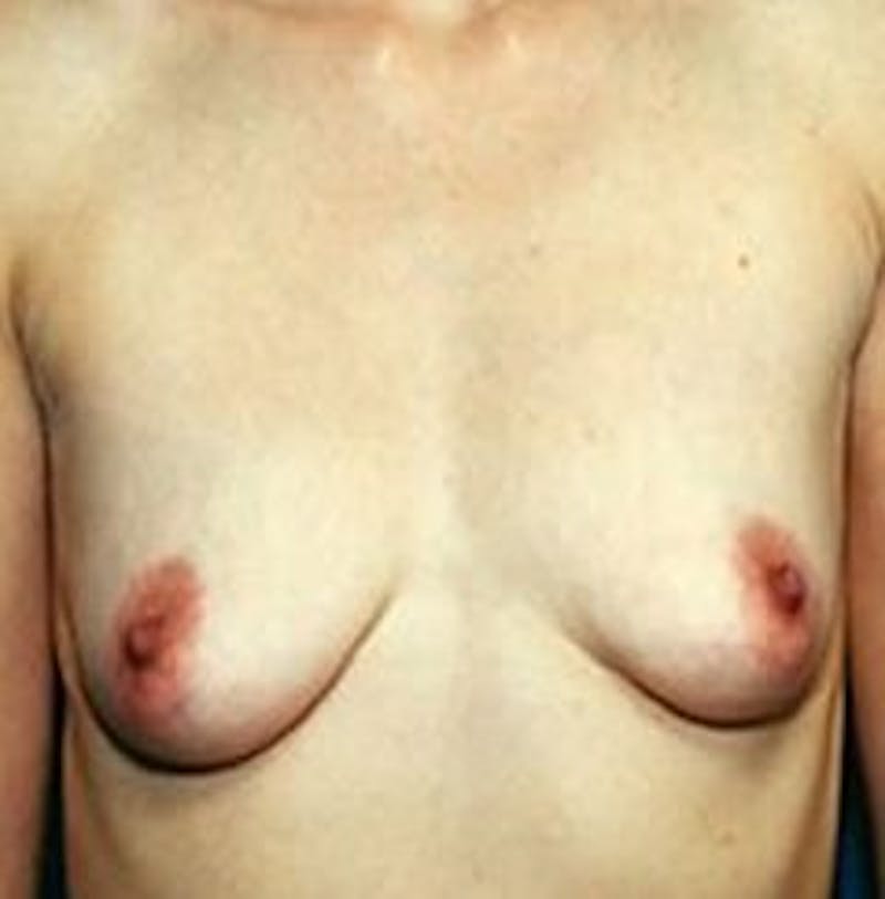 Breast Augmentation Before & After Gallery - Patient 18242314 - Image 1