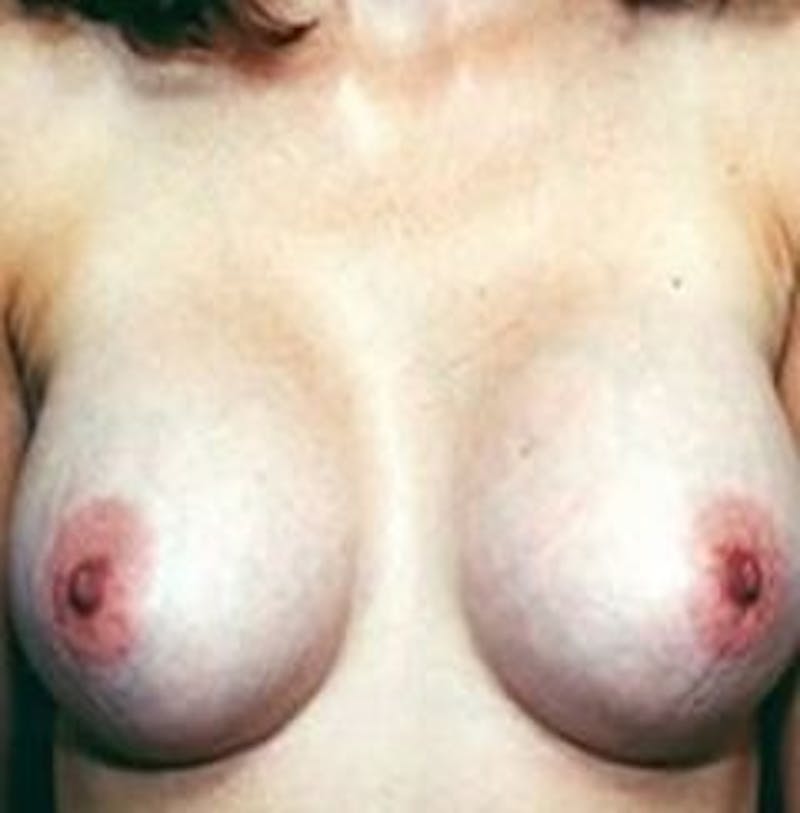 Breast Augmentation Before & After Gallery - Patient 18242314 - Image 2