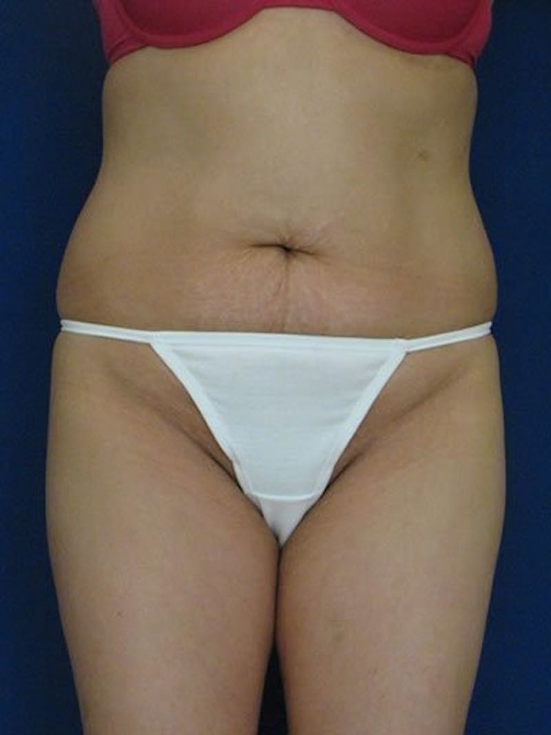 Abdominoplasty / Tummy Tuck Before & After Gallery - Patient 18242315 - Image 1