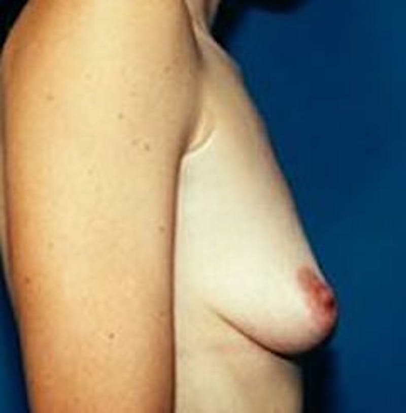 Breast Augmentation Before & After Gallery - Patient 18242314 - Image 3