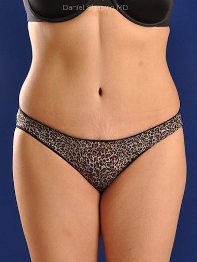 Abdominoplasty / Tummy Tuck Before & After Gallery - Patient 18242315 - Image 2