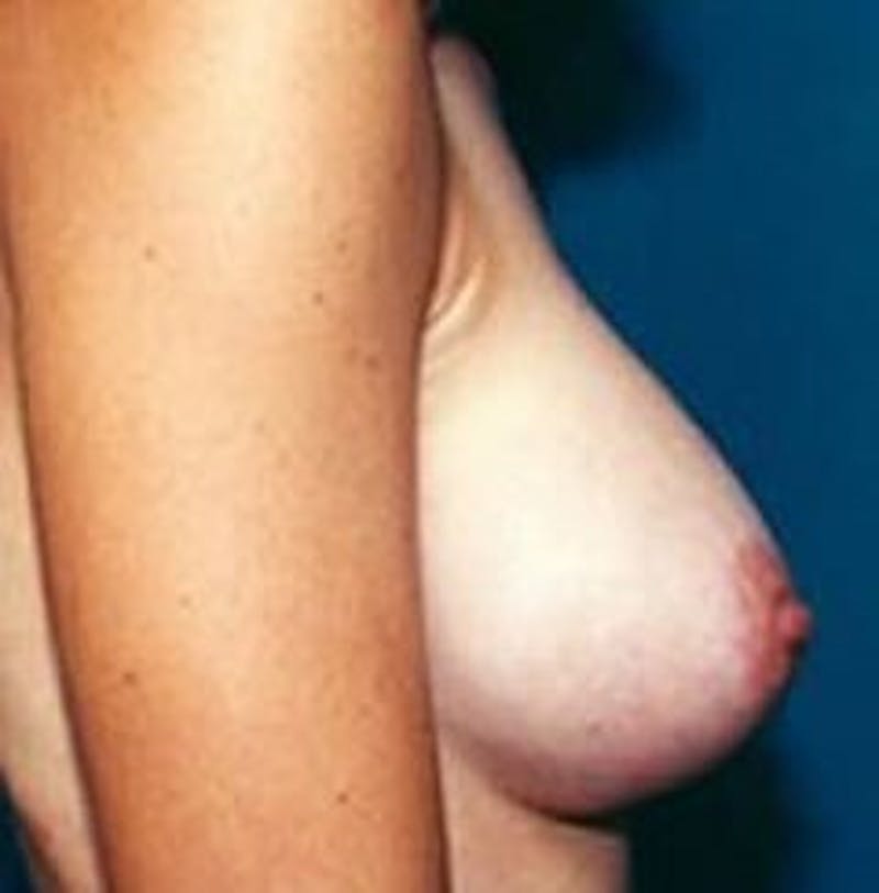 Breast Augmentation Before & After Gallery - Patient 18242314 - Image 4