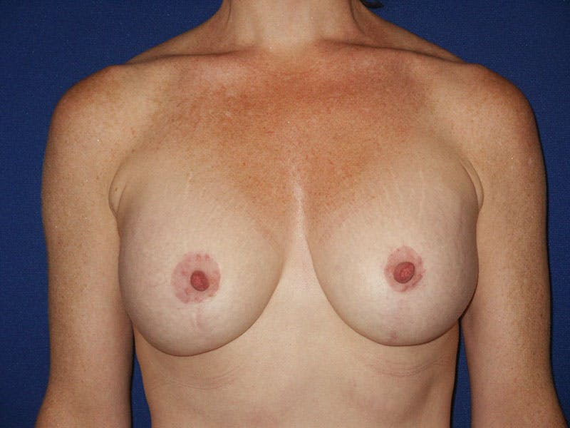 Breast Lift With Augmentation Before & After Gallery - Patient 18242317 - Image 2