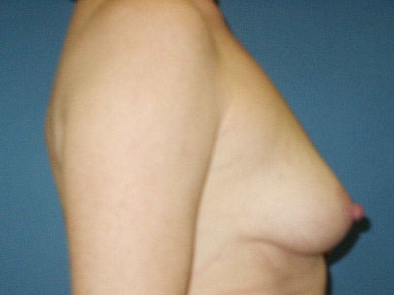 Breast Lift With Augmentation Before & After Gallery - Patient 18242317 - Image 5