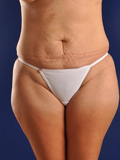 Abdominoplasty / Tummy Tuck Before & After Gallery - Patient 18242320 - Image 1