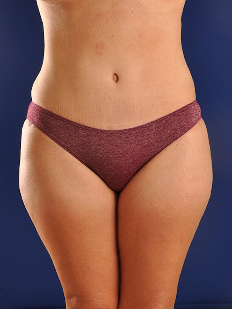 Abdominoplasty / Tummy Tuck Before & After Gallery - Patient 18242320 - Image 2