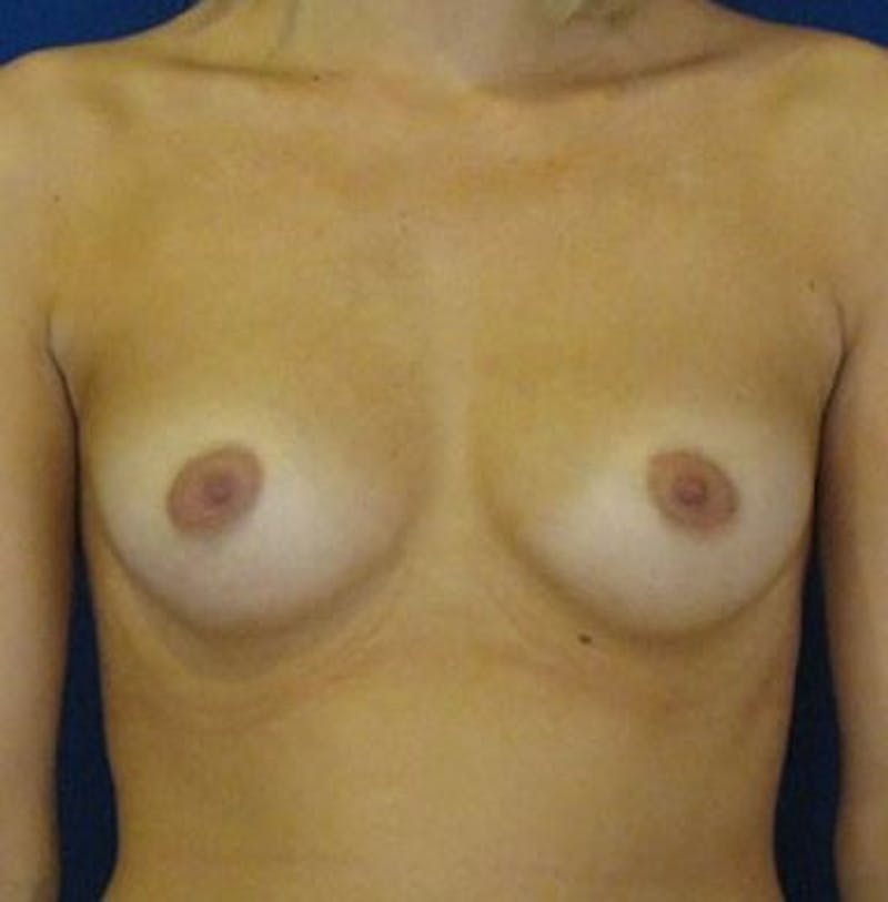 Breast Augmentation Before & After Gallery - Patient 18242318 - Image 1