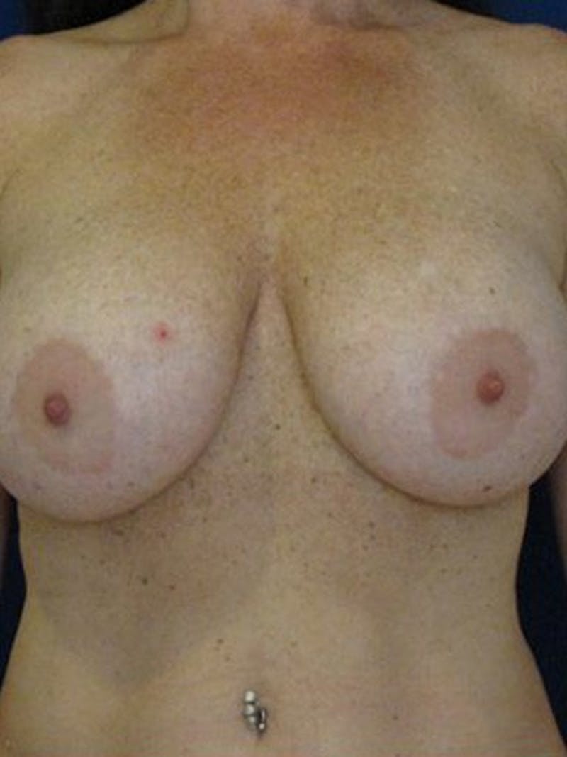 Breast Lift With Augmentation Before & After Gallery - Patient 18242319 - Image 1