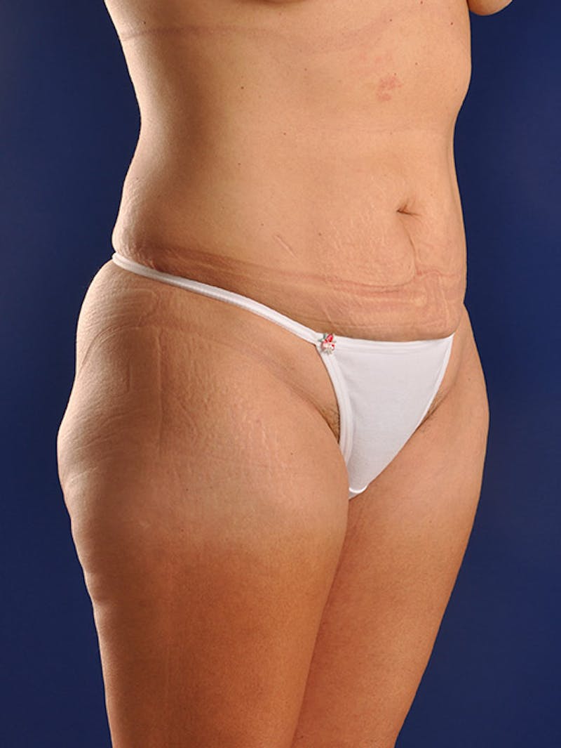 Abdominoplasty / Tummy Tuck Before & After Gallery - Patient 18242320 - Image 3