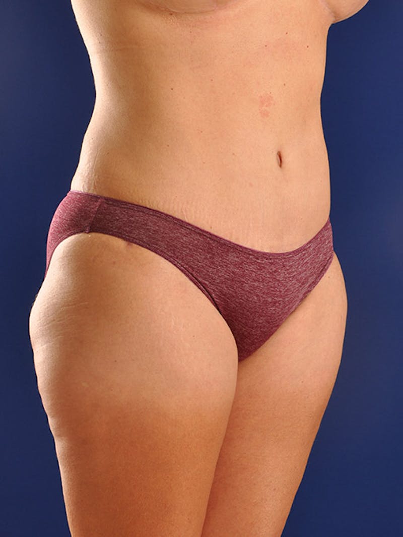 Abdominoplasty / Tummy Tuck Before & After Gallery - Patient 18242320 - Image 4