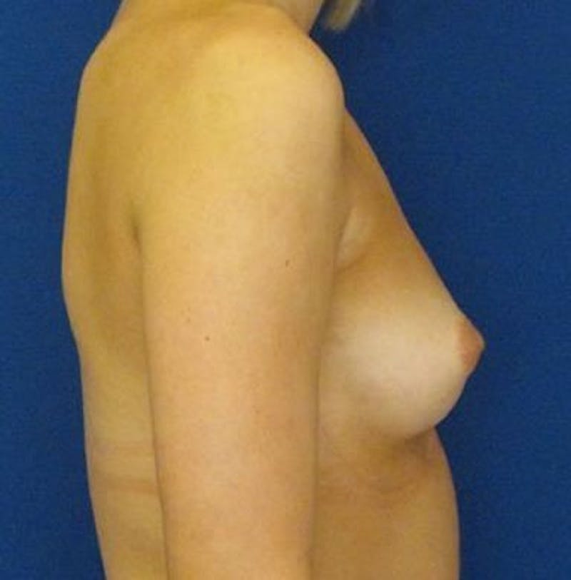 Breast Augmentation Before & After Gallery - Patient 18242318 - Image 3