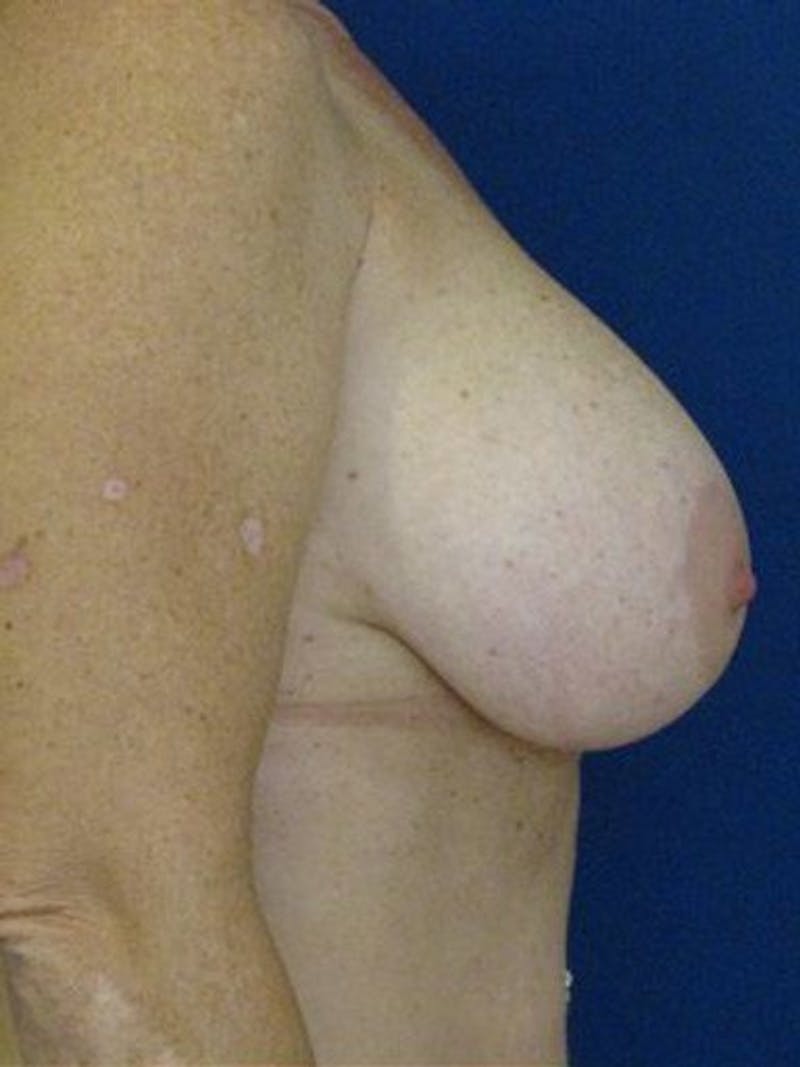 Breast Lift With Augmentation Before & After Gallery - Patient 18242319 - Image 3