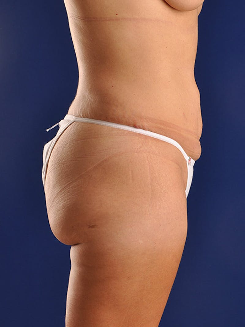 Abdominoplasty / Tummy Tuck Before & After Gallery - Patient 18242320 - Image 5
