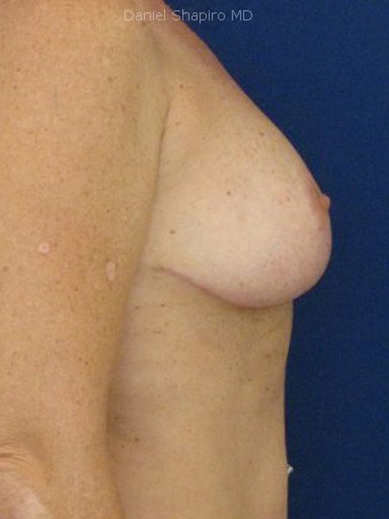 Breast Lift With Augmentation Before & After Gallery - Patient 18242319 - Image 4